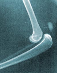 Röntgenfoto van een ontwrichte knie