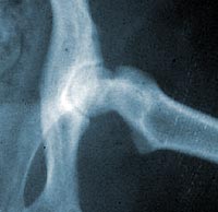 Röntgenfoto artritis heup